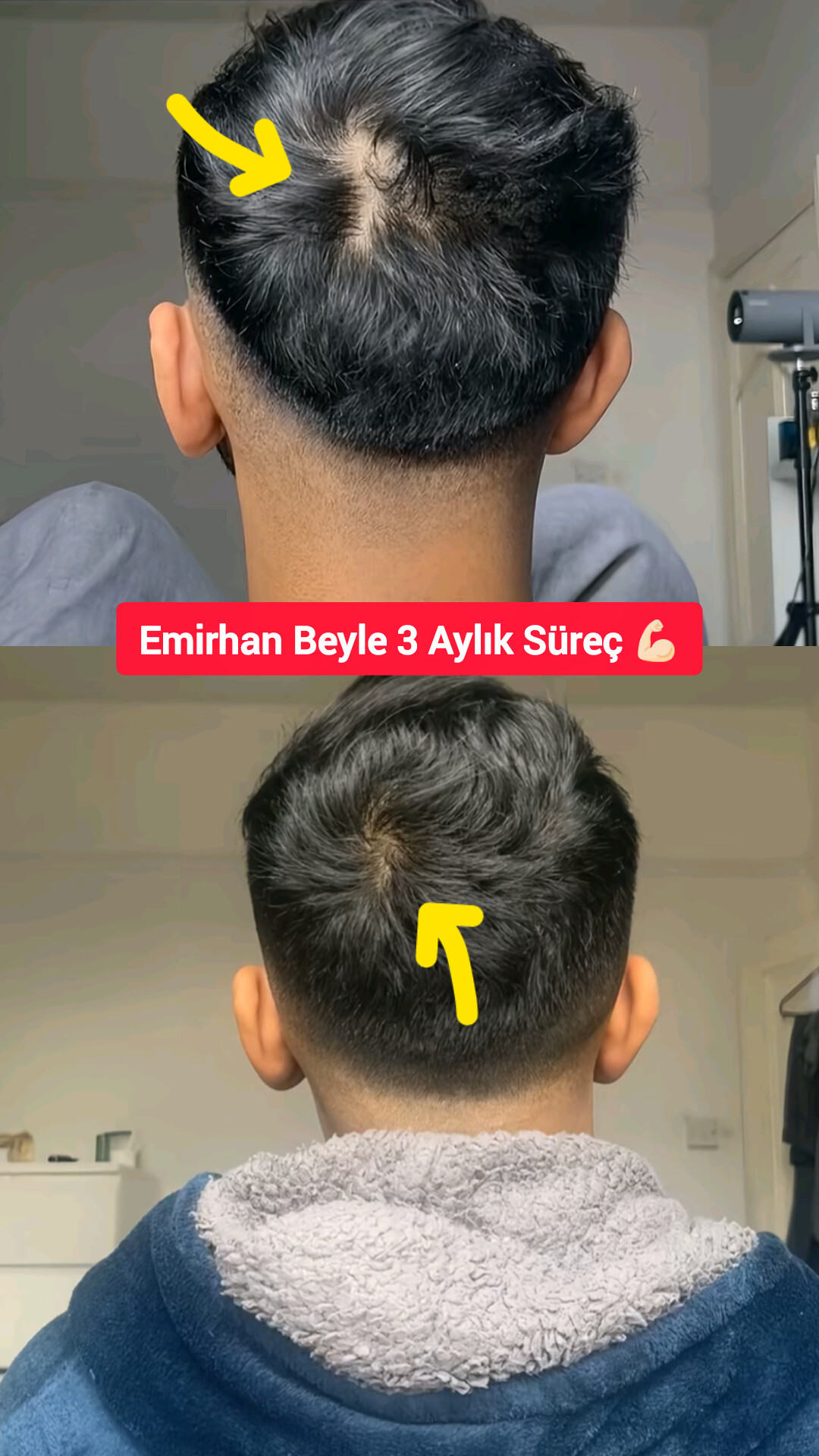 Emirhan Bey - 3 aylık saç gelişim süreci